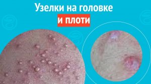😦 Узелки на головке и плоти. Клинический случай №1569
