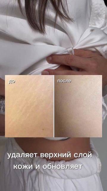 Аппараты с RF-лифтингом: ReadySkin nanoSkin, ReadySkin Eva борются с растяжками на клеточном уровне смотреть онлайн