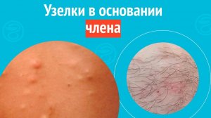 😯 Узелки в основании члена. Клинический случай №1571