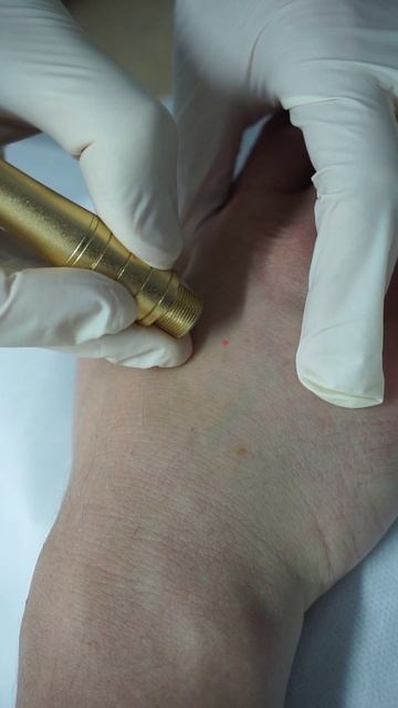 Плоские Папилломы На Руке- Лазерное Удаление смотреть онлайн