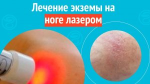 🦵 Лечение экземы на ноге лазером. Клинический случай №1567