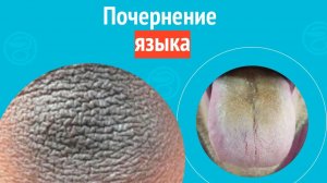 👅 Почернение языка. Клинический случай №1565