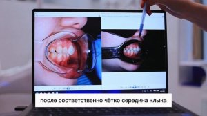 Дистальный прикус на брекетах за 1,5 года. До/после