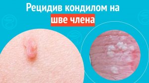 😧 Рецидив кондилом на шве члена. Клинический случай №1556