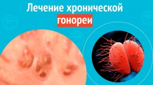 ✅ Лечение хронической гонореи. Клинический случай №1552