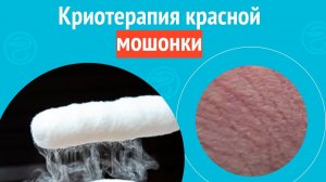 ✅ Криотерапия красной мошонки. Клинический случай №1560