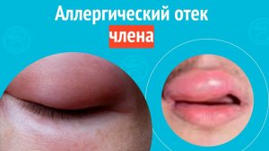 👉 Аллергический отек члена. Клинический случай №1568