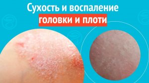 🥺 Сухость и воспаление головки и плоти. Клинический случай №1553