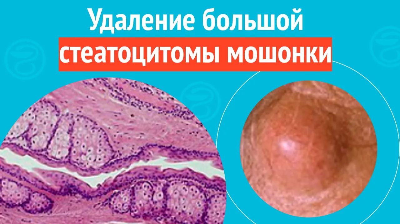 ➡️ Удаление большой стеатоцитомы мошонки. Клинический случай №1555