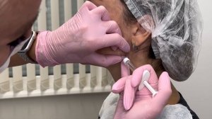 Углы Джоли. Контурная пластика лица. Как сделать четкие симметричные углы филлером