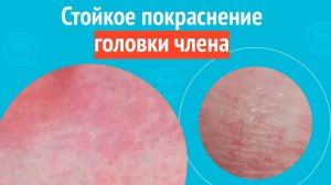 😡 Стойкое покраснение головки члена. Клинический случай №1592