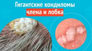 😱 Гигантские кондиломы члена и лобка. Клинический случай №1585