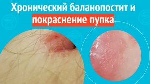 😮 Хронический баланопостит и покраснение пупка. Клинический случай №1597