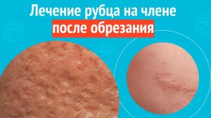 ✅ Лечение рубца на члене после обрезания. Клинический случай №1604
