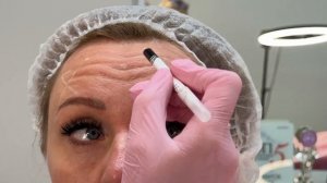 Техника работы с ботулотоксином. Верхняя треть