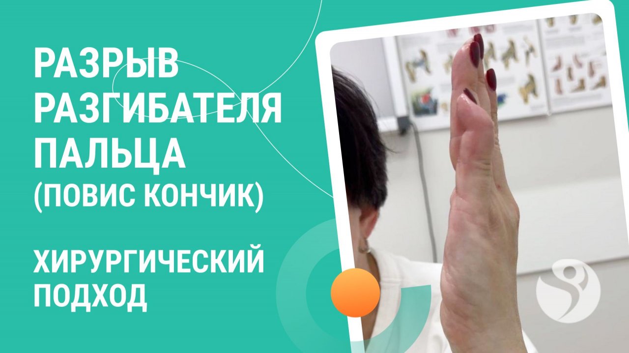 🧐 Разрыв разгибателя пальца (повис кончик). Хирургический подход