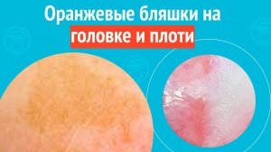 👉 Оранжевые бляшки на головке и плоти. Клинический случай №1583