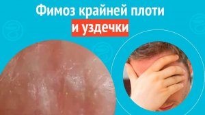 😒 Фимоз крайней плоти и уздечки. Клинический случай №1617