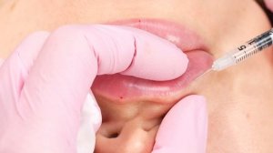 Ботулотоксин в губы | Как при помощи ботулотоксина развернуть губу? | Техника