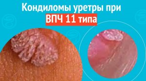 😰 Кондиломы уретры при ВПЧ 11 типа. Клинический случай №1615