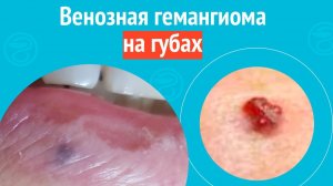 👄 Венозная гемангиома на губах. Клинический случай №1624