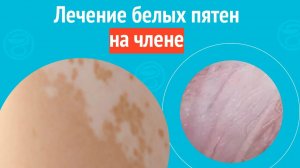 💉 Лечение белых пятен на члене. Клинический случай №1625