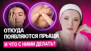 Почему у вас появляются прыщи и как их правильно лечить: полный гайд