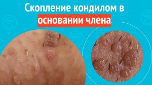 👉 Скопление кондилом в основании члена. Клинический случай №1620