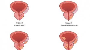 САМЫЙ ПОЗНАВАТЕЛЬНЫЙ КАНАЛ. ВСЁ О РАКЕ ПРОСТАТЫ.