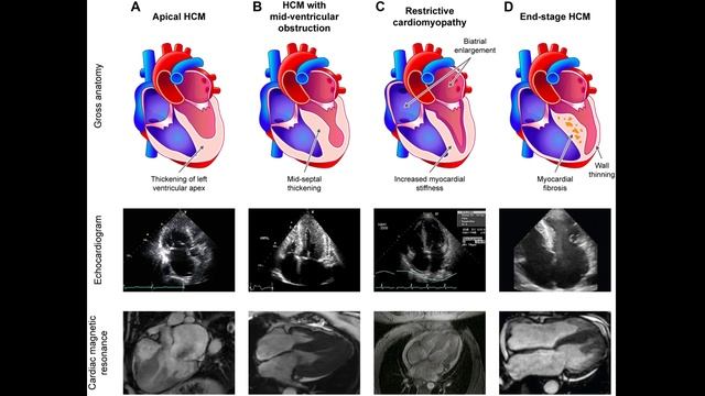 Скрытая (необструктивная) гипертрофическая кардиомиопатия: патофизиология, диагностика и лечение