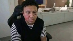 Блогер SUBO показал, как он выглядит после того, как его избил чеченский боец MMA Шовхал Чурчаев