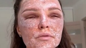 Россиянки уродуют себя процедурами лазерной шлифовки лица. Один сеанс стоит до 60,000 рублей