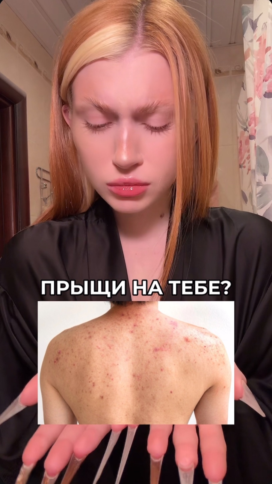 от прыщей на теле смотреть онлайн