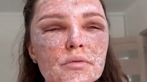 Россиянки уродуют себя процедурами лазерной шлифовки лица. Один сеанс стоит до 60,000 рублей👉🙄