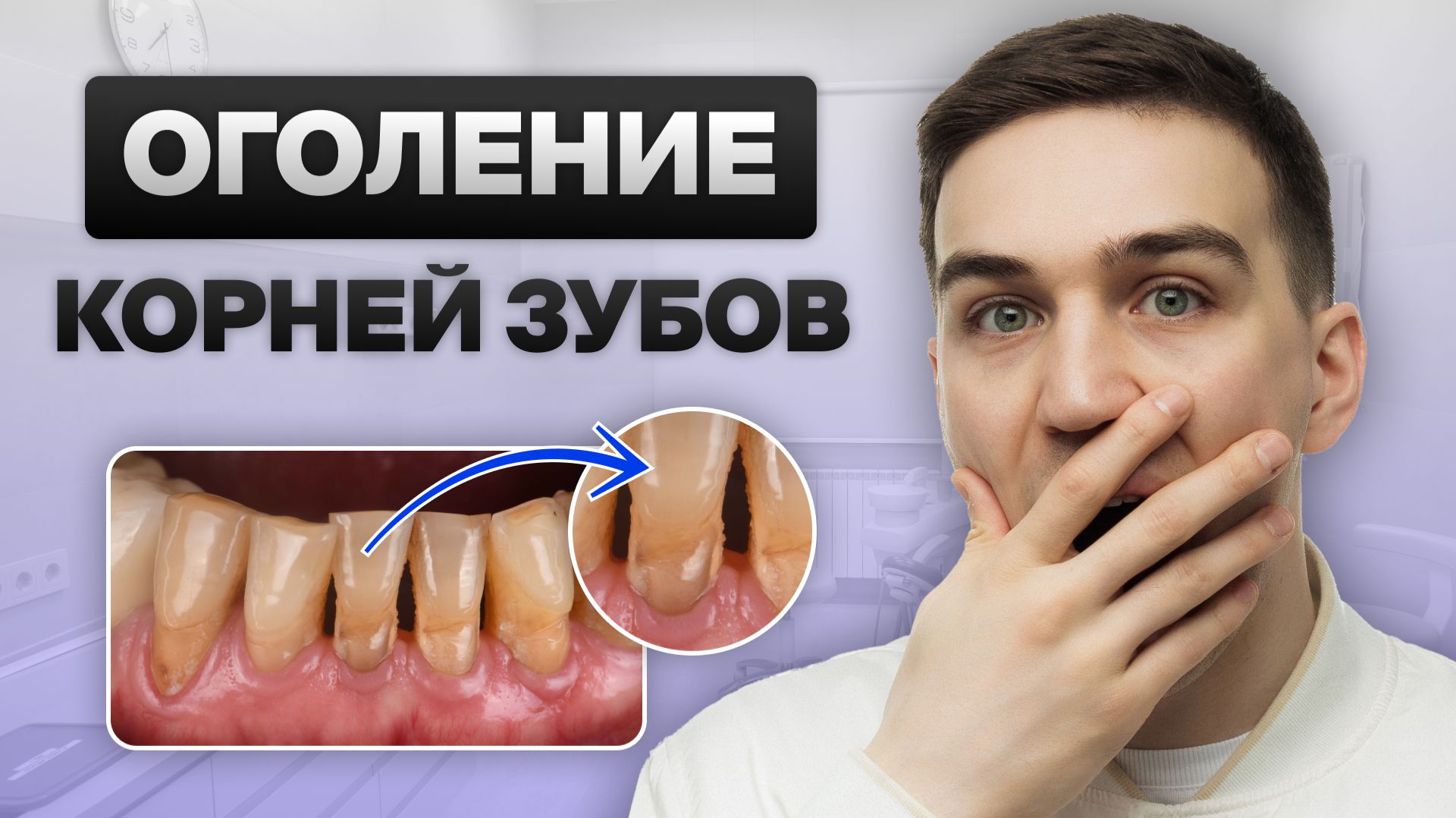 Оголение корней зубов