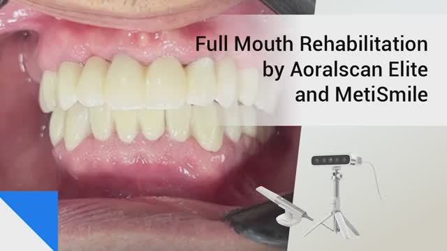 Полная реабилитация полости рта с помощью AoralScan Elite и MetiSmile
