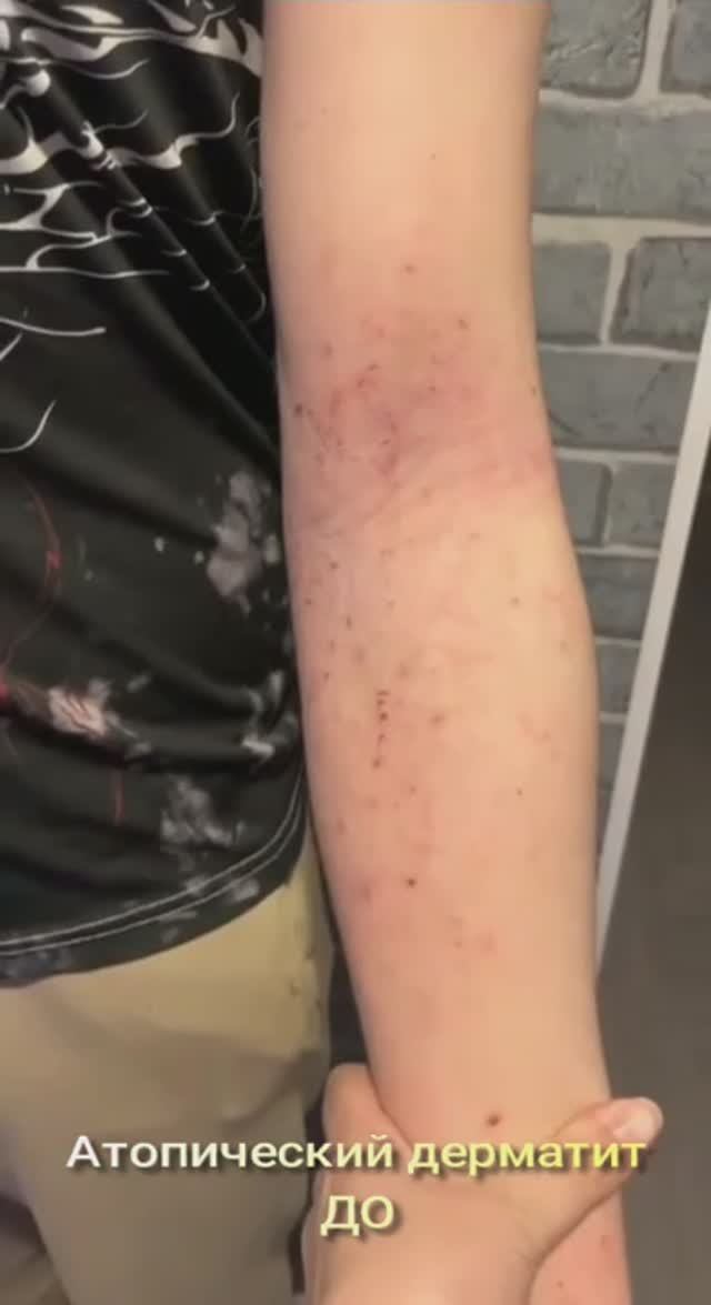 Атопический дерматит у подростка. Неорезерво справился с ним лучше врачей и лекарств.