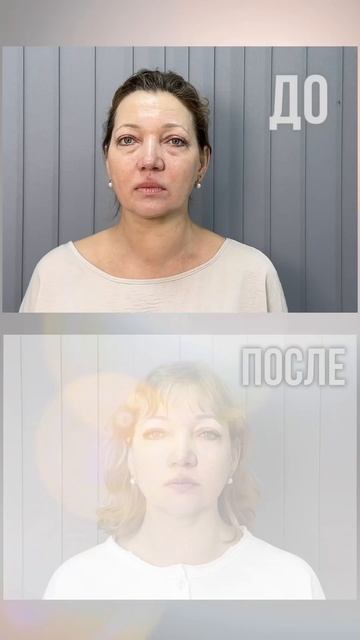 Результаты Микроигольчатого RF лифтинга в клиниках Абрикосик