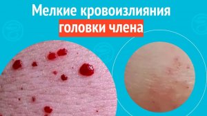 😢 Мелкие кровоизлияния головки члена. Клинический случай №1636