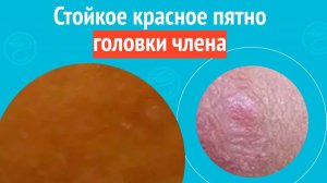 😡 Стойкое красное пятно головки члена. Клинический случай №1638