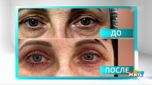 Грыжи век: кто прав - офтальмолог или пластический хирург? Жить здорово! Фрагмент выпуска от 04.1...