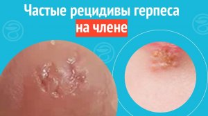 😮 Частые рецидивы герпеса на члене. Клинический случай №1667