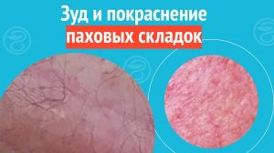 😡 Зуд и покраснение паховых складок. Клинический случай №1655