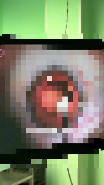 Монофокальная иол с углубленным фокусом