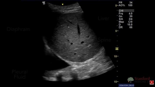 5 Point of Care Lung Ultrasound Stanford рус