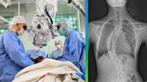 Российские врачи разработали уникальную технологию лечения искривления позвоночника у детей