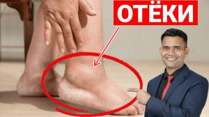 РЕАЛЬНАЯ ПРИЧИНА ОТЁКОВ. ДОКТОР ВИВЕК.