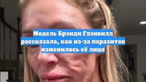 Модель Брэнди Глэнвилл рассказала, как из-за паразитов изменилось её лицо
