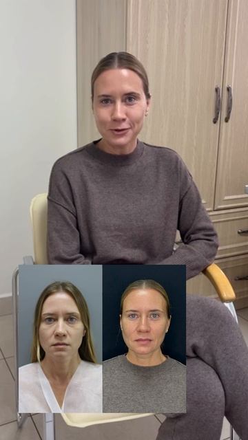 Отзыв пациентки спустя 1,5 года после верхней блефаропластики смотреть онлайн