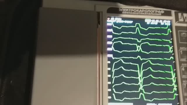 ПБЛНПГ Полная Блокада Левой Ножки Пучка Гиса смотреть онлайн
